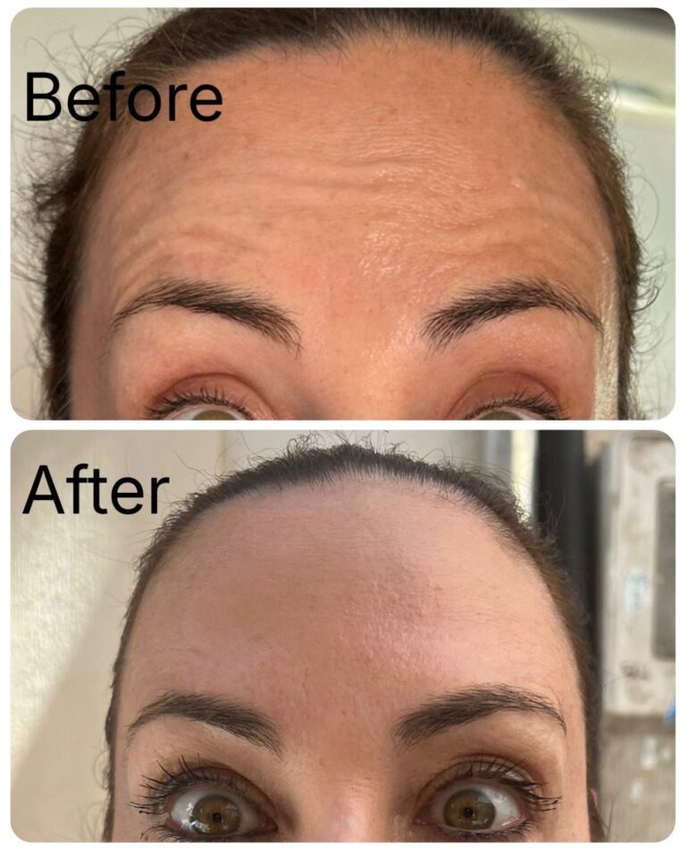 Botox forehead before and after at Ageless Aesthetics
