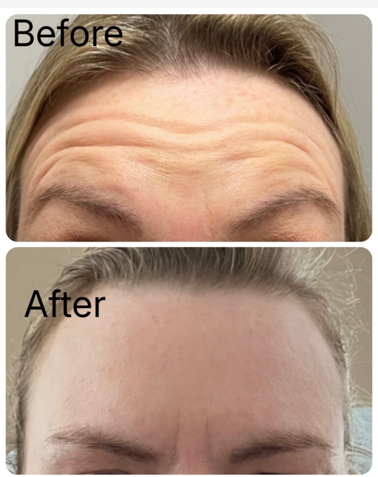 Botox forehead before and after at Ageless Aesthetics
