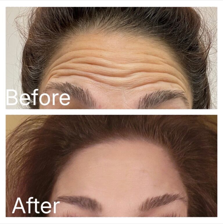 Botox forehead before and after at Ageless Aesthetics