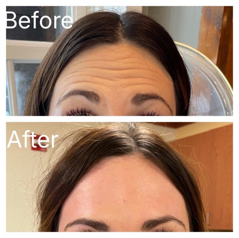 Botox forehead before and after at Ageless Aesthetics
