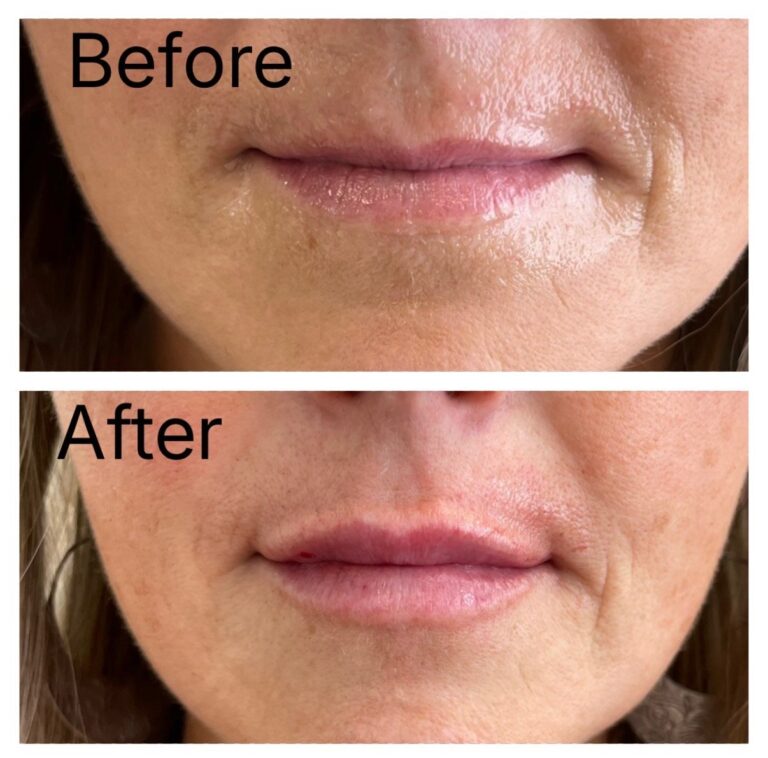 Lip filler before and after at Ageless Aesthetics