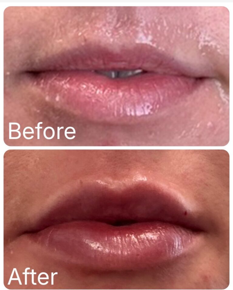Lip filler before and after at Ageless Aesthetics