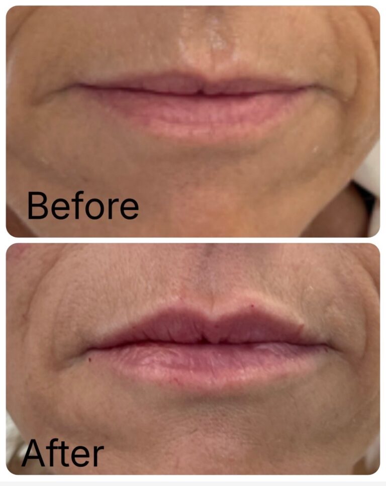 Lip filler before and after at Ageless Aesthetics
