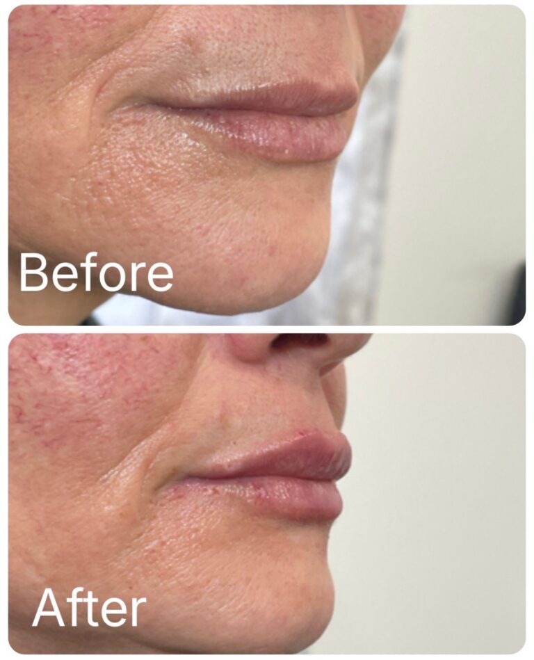 Lip filler before and after at Ageless Aesthetics
