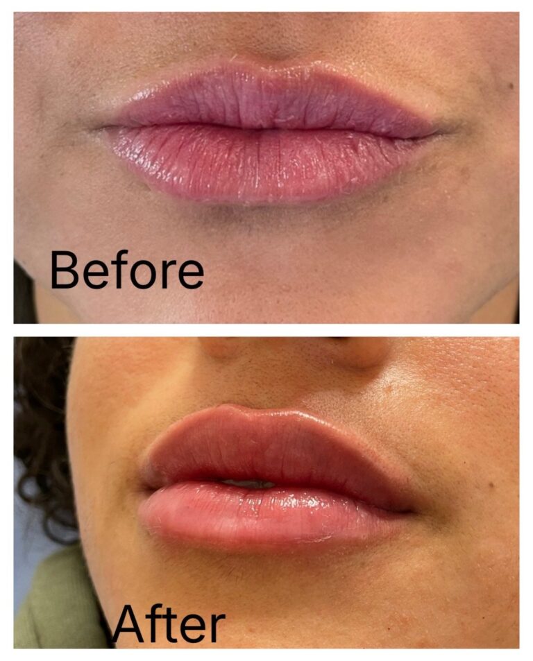 Lip filler before and after at Ageless Aesthetics