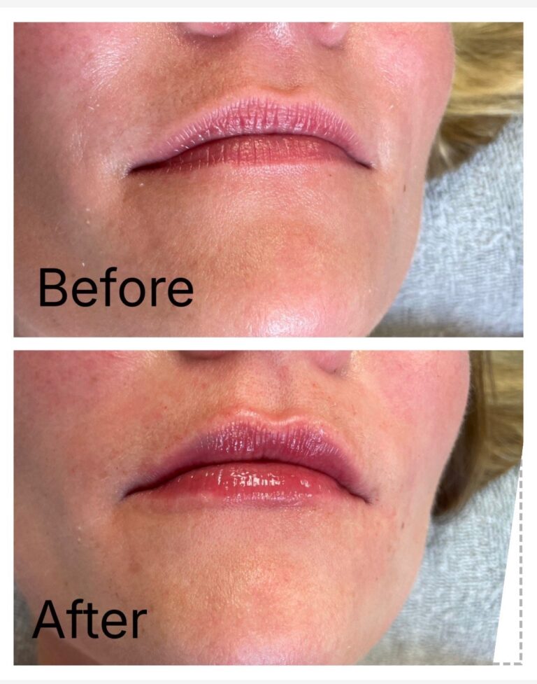 Lip filler before and after at Ageless Aesthetics